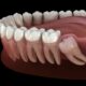 Model of teeth with impacted wisdom tooth needing removal
