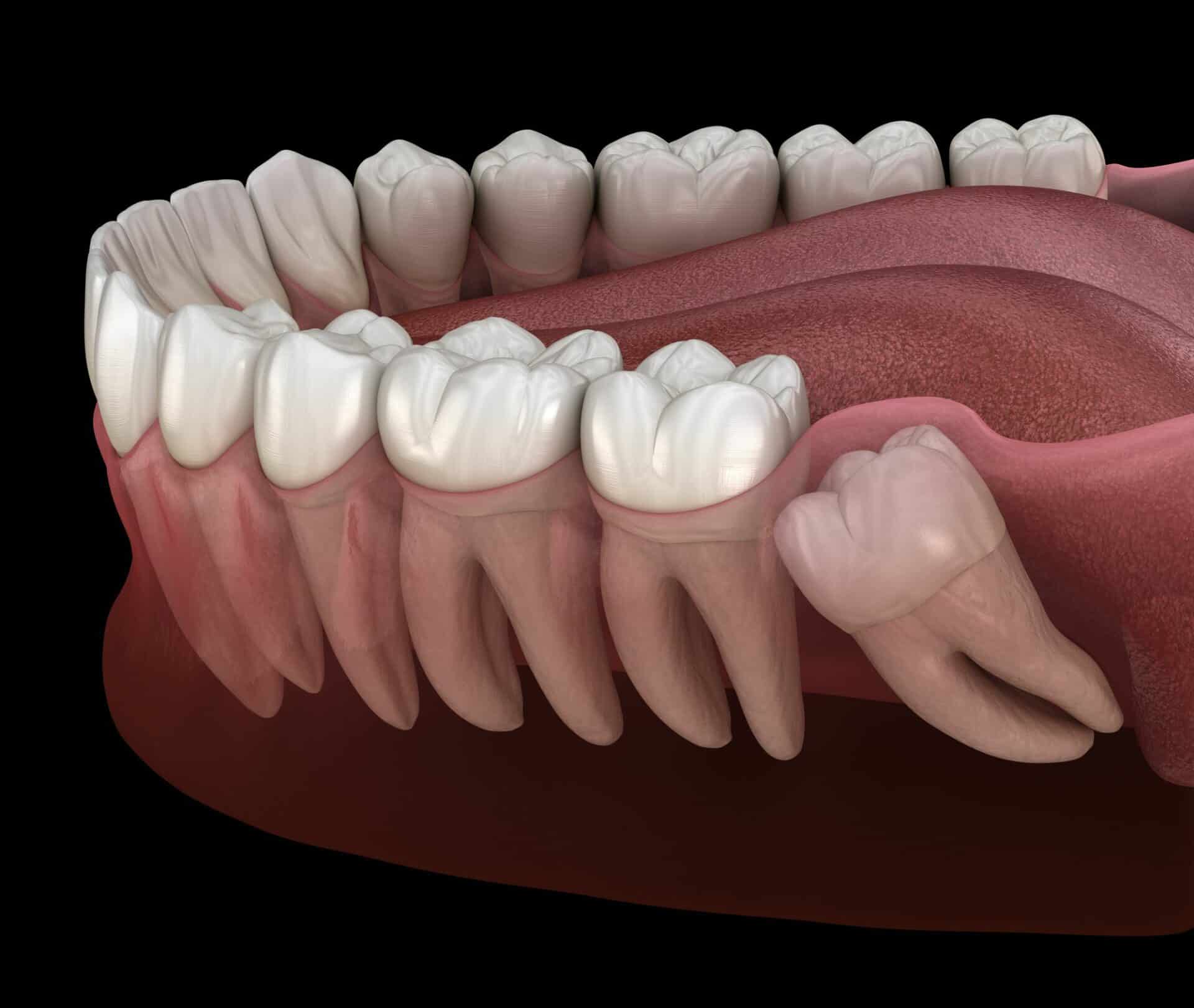 Model of teeth with impacted wisdom tooth needing removal