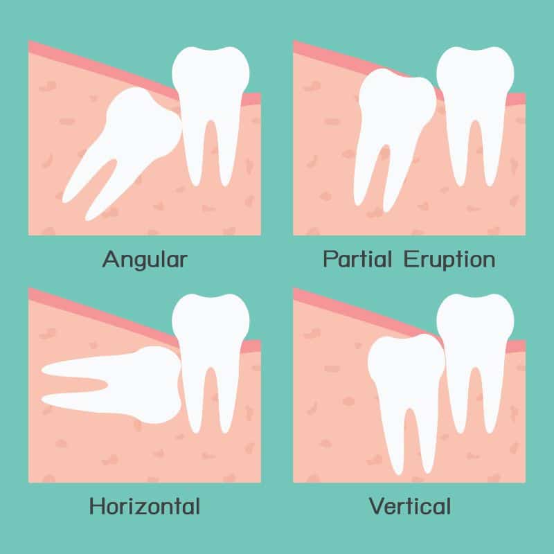 Image showing different positions of wisdom teeth to determine simple or surgical extraction