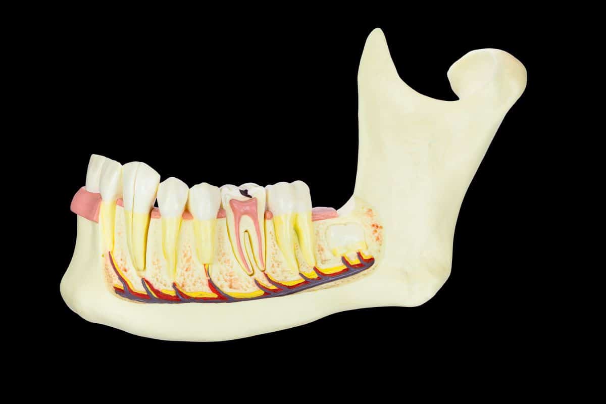 wisdom teeth removal, side image of jawbone