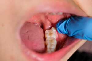 dentist showing impacted wisdom teeth that needs removal. Hamilton