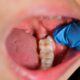 dentist showing impacted wisdom teeth that needs removal. Hamilton